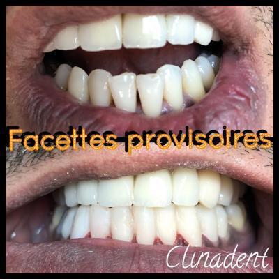 Réalisation de facettes dentaires au Centre Clinadent à Marseille 7 ème