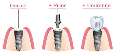 Composants implant dentaire Marseille 13007